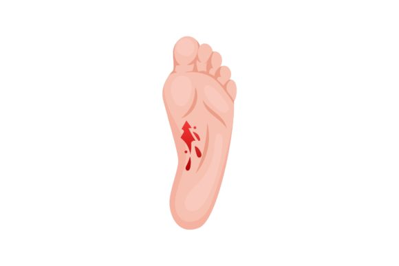 Download Open Laceration on Heel, Lower Part of F - Art Collection